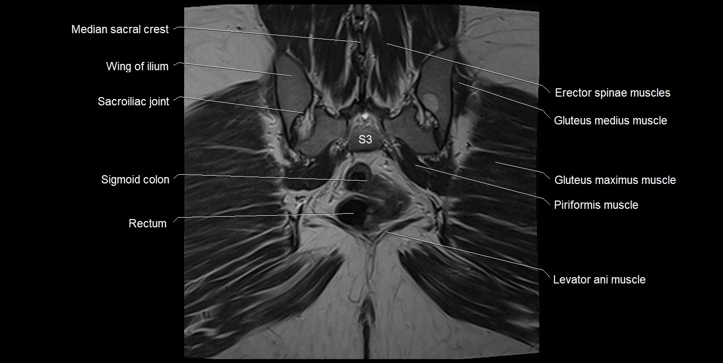 female pelvis coronal cross sectional anatomy image 31.webp